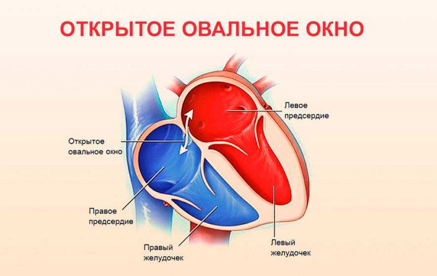 Дырки в сердце