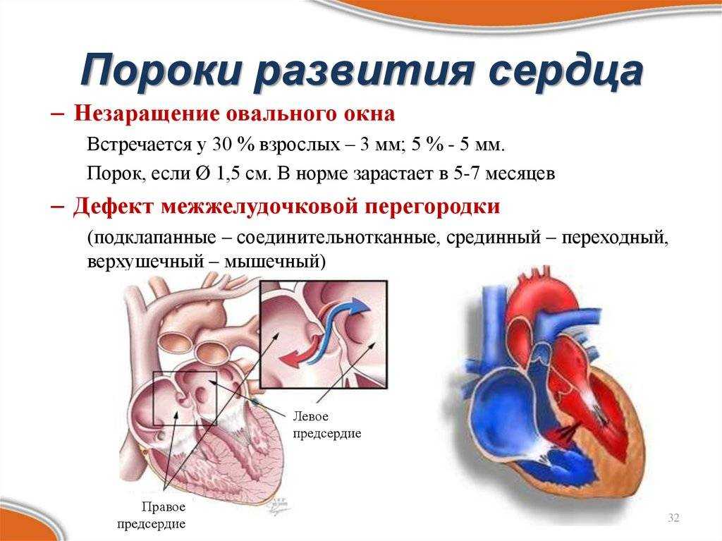 Что чувствует клапан с дырявым сердцем?