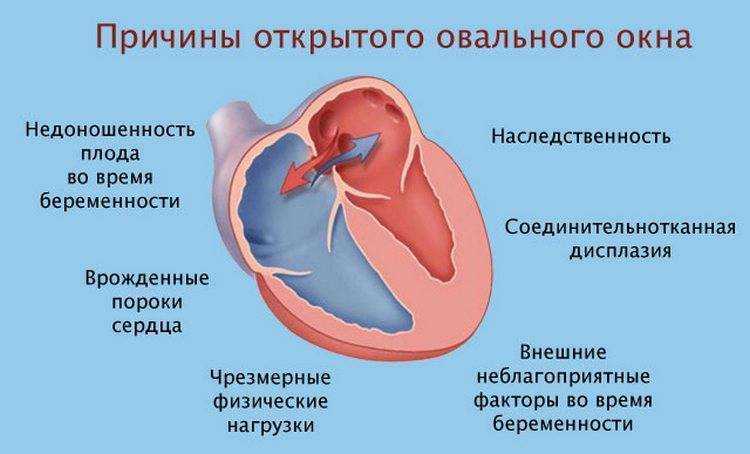 Открытое овальное окно в сердце у детей и взрослых - понятие, причины незакрытия, течение и тактика лечения
